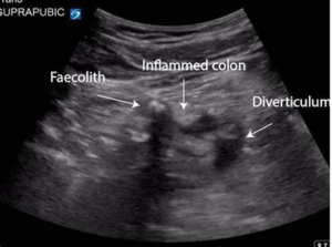 imaging findings of diverticulitis