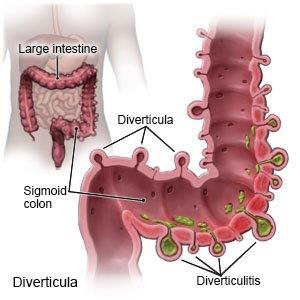 Diverticula Along