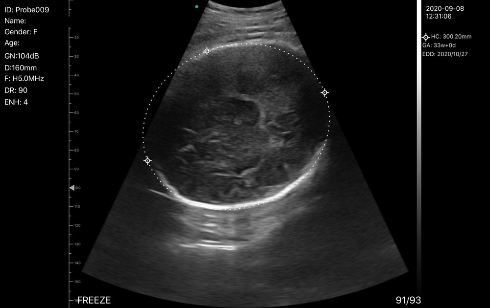 WTIO-1 Wireless Transducer ultrasound